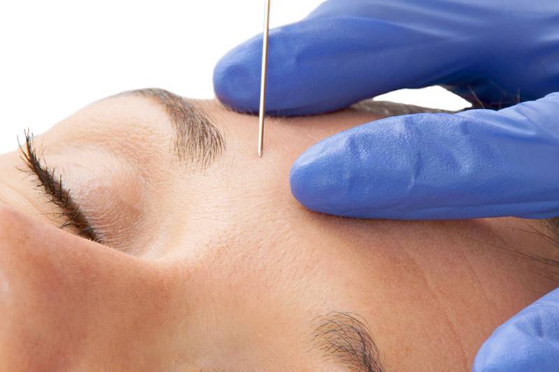 Botox treatment of the forehead against expression lines at the Arkona Strandhotel on Rügen by medical specialists.